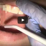 VIDEO len pre silné povahy: Takto vyzerá extrakcia zubu múdrosti z pohľadu zubára!