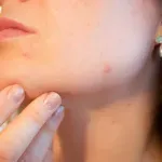Акне по брадичката: всичко, което всяка жена трябва да знае