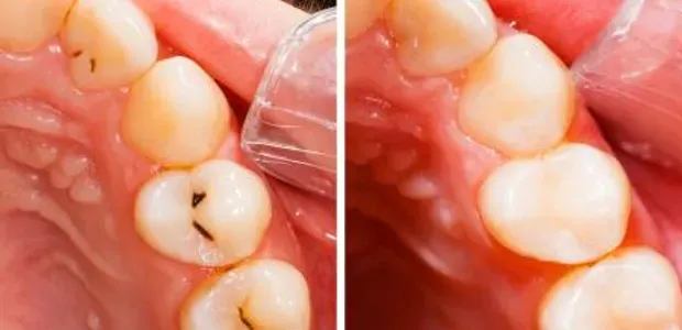 Kako pozdraviti karies brez zobozdravnikov?