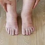 Poletna vročina in otekle noge: kako si lahko pomagate sami?
