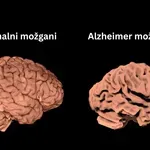 Ta aminokislina močno zmanjša poškodbe pri Alzheimerjevi bolezni