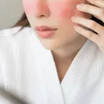 3 életmódbeli változtatás, amivel csökkentheted a rosacea tüneteit
