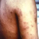 Nakon potvrđenog slučaja gube stižu upozorenja: "Ne znamo njihovo zdravstveno stanje, ni cijepni status"