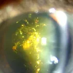 Rijetka bolest očiju čini da svjetlucaju poput božićnog drvca