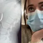 Bizarna nezgoda ostavila ju sa žlicom u želucu, a za sve je kriv pas