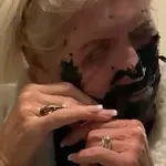 Je li ljepota vrijedna tolike boli? Pohvalili se zahvatima koje je bolno gledati