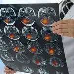 Revolucionarna studija tvrdi da nedostatak ovog ključnog nutrijenta može utjecati na razvoj Alzheimerove bolesti