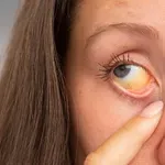 Žutica kod beba, djece i odraslih: Kako je prepoznati, kako se liječi i koliko traje?