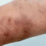 Svrab (šuga ili scabies): Možete ga imati, a da to ni ne znate – obratite pažnju na ove simptome