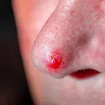 Bazocelularni karcinom: Ovaj rak kože mnogi zamijene za aknu ili ožiljak