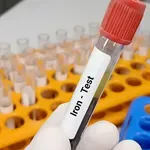 Željezo u krvi: Koje su normalne vrijednosti, simptomi niskog/povišenog željeza i kako ga povećati ili smanjiti?