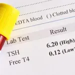 Povišen TSH i hipotireoza: Što znači vaš nalaz i trebate li odmah reagirati?
