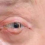 Bakterijski konjunktivitis: Koji su simptomi, koliko traje i kako se liječi?