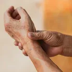 Sudeckov sindrom (Sudeckova distrofija): Može se razviti nakon ozljede, operacije ili infarkta – evo kako ga prepoznati