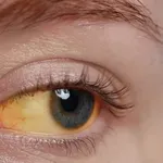 Hepatitis A (infektivni hepatitis): Koji su simptomi bolesti “prljavih ruku”?