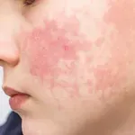 Peta bolest (parvovirus) kod djece: Ovaj čest virus širi se poput prehlade – evo kako ga prepoznati na vrijeme