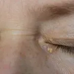 Simptomi bolesti jetre na koži: Ako imate neku od ovih 9 kožnih promjena, obavezno provjerite jetru!