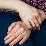 Dishidrotični ekcem: Ovaj tihi kožni poremećaj pogađa sve više ljudi – prepoznajte simptome na vrijeme!