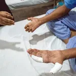 Guba: Simptomi drevne bolesti koja se pojavila i u Hrvatskoj – treba li se brinuti?