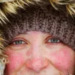 Suha i crvena koža nakon boravka na vjetru? Evo što trebate znati o opeklinama od vjetra