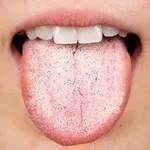 Bolesti jezika: Što vam boja, peckanje i naslage na jeziku zapravo poručuju?