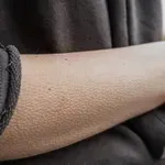 Ježenje kože: Ovaj osjećaj u tijelu ima više uzroka nego što mislite