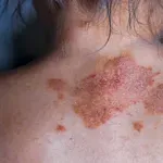 5 čestih navika koje pogoršavaju simptome psorijaze