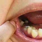 Crna plomba na zubu: EU je zabranjuje! Evo zašto biste je trebali zamijeniti što prije