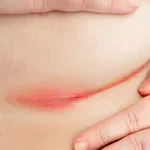 Inverzna psorijaza: Crvene, sjajne promjene na intimnim dijelovima koji mnogi zamijene za gljivice