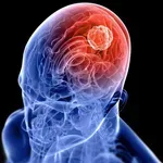 Vrste tumora na mozgu: Koji su bezopasni, a koji najčešće završavaju kobno?