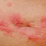 Herpes zoster ispod grudi: Ovo su prvi znakovi koje žene najčešće ignoriraju
