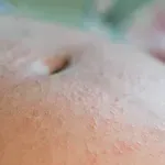 Papilarni dermatitis u trudnoći: Zašto se pojavljuju kvržice koje jako svrbe i treba li se zabrinuti?