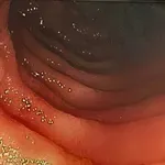 Peutz-Jeghersov sindrom: Rijetka bolest koja povećava rizik od raka čak do 93 %