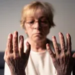 Reumatoidni artritis i životni vijek: 5 opasnih komplikacija koje mogu biti kobne