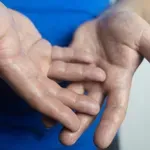 Znojenje (hiperhidroza) dlanova: Zašto se događa i kako ga smanjiti ili zaustaviti?