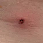 Bolesti od krpelja: Ovi simptomi znače da morate odmah liječniku