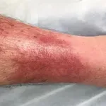 Celulitis: Simptomi koje mnogi ignoriraju – a mogu dovesti do ozbiljnih komplikacija