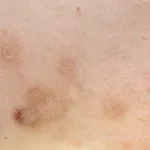 Keto osip: Ako vidite ovaj uzorak na koži, vrijeme je za promjenu prehrane!