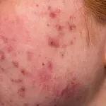 Kortikosteroidi i akne: Zašto vam terapija može uništiti kožu?