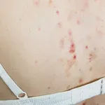Mehaničke akne: Ove akne nemaju veze s hormonima – evo što ih zapravo uzrokuje i kako se liječe