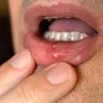 Mukozitis: Nuspojava liječenja raka o kojoj se premalo govori – može vas spriječiti da jedete