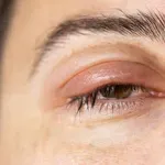 Otečeni kapci i bubrezi: Jedan pogled u ogledalo može otkriti ozbiljan problem