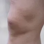 Prirodni lijek za vodu u koljenu: 5 jednostavnih obloga koji “ispuhuju” koljeno