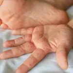 Bolest usta, šaka i stopala širi se vrtićima brže nego što mislite! Evo prvih simptoma