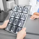 Oporavak nakon operacije raka pluća: Što možete očekivati i kako si olakšati simptome?