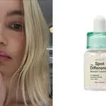 Kako ukloniti akne za 24 sata – Top SOS skincare guide