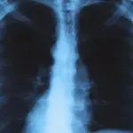 Жена почина от легионерска болест в Бургас