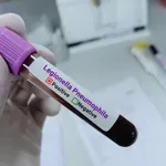 Жена от Бургас почина от легионерска болест