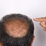 Във Великобритания печелят битката с оплешивяването с нов препарат