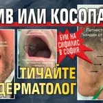 БУМ НА СИФИЛИС В СОФИЯ: Обрив или косопад - тичайте при дерматолог